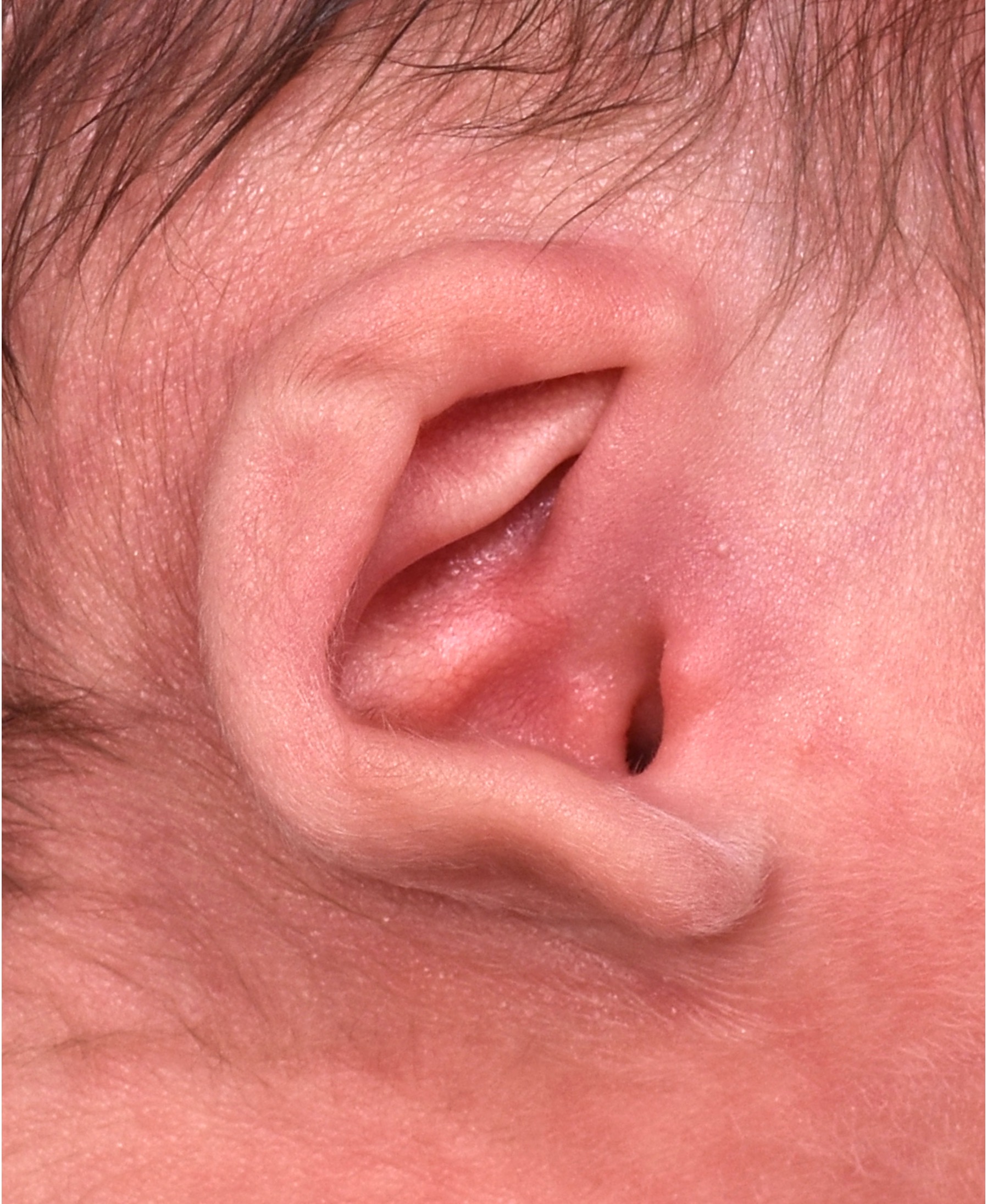 Earwell newborn baby ear treatment otoplasty best