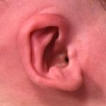 Earwell newborn baby ear treatment otoplasty best