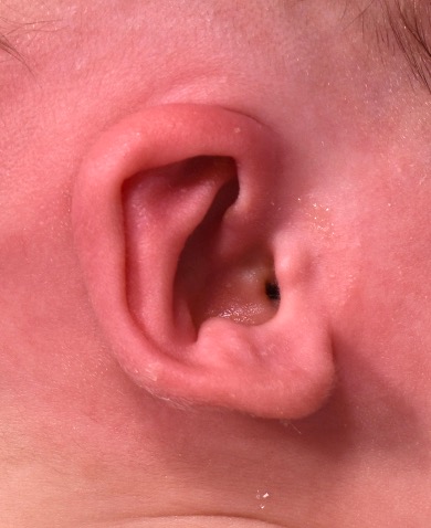 Earwell newborn baby ear treatment otoplasty best