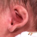 Earwell newborn baby ear treatment otoplasty best