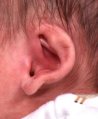 Earwell newborn baby ear treatment otoplasty best