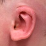 Earwell newborn baby ear treatment otoplasty best