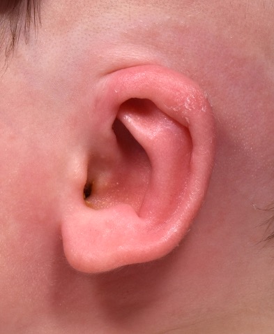 Earwell newborn baby ear treatment otoplasty best