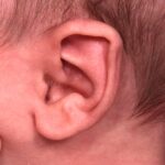 Earwell Atlanta Aviva baby ear before after expert best