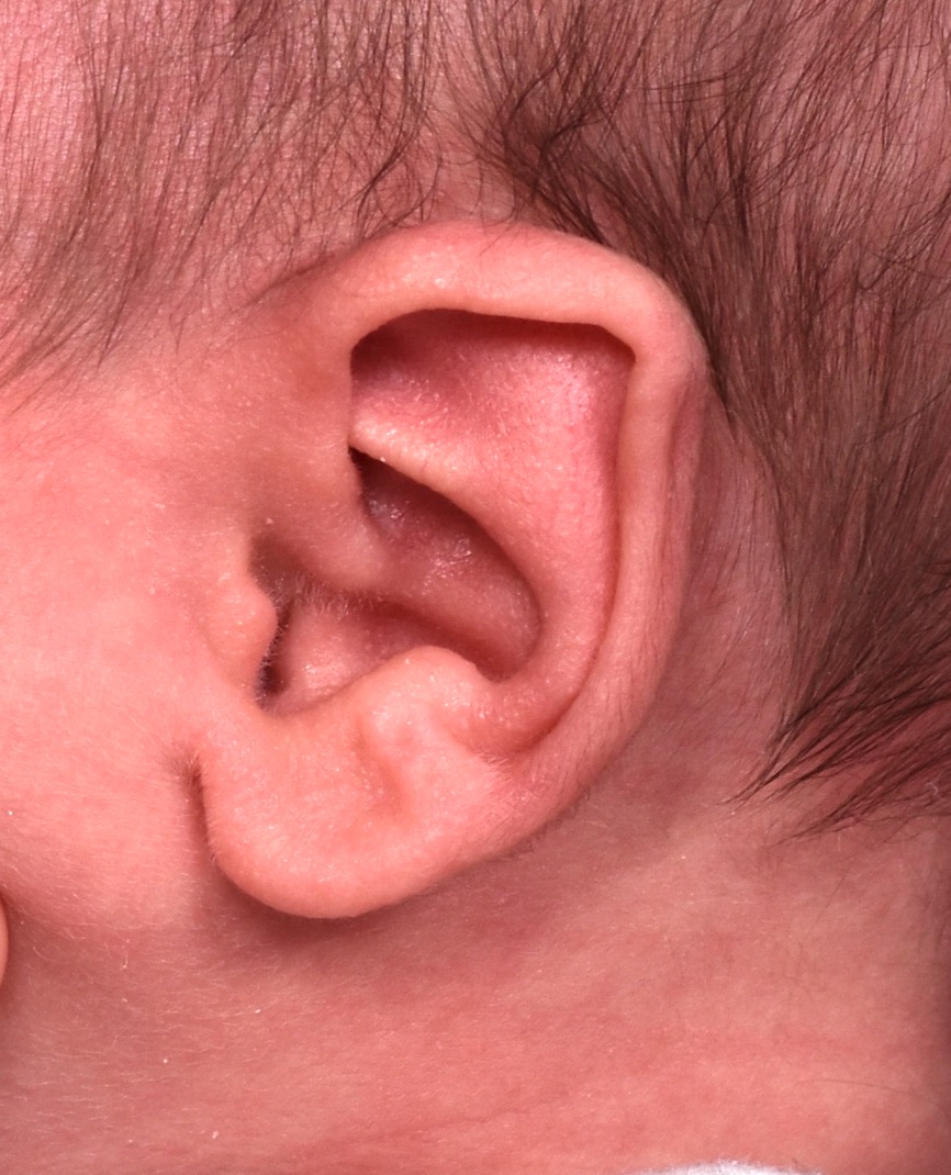 Earwell Atlanta Aviva baby ear before after expert best