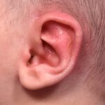 Earwell Atlanta Aviva baby ear before after expert best