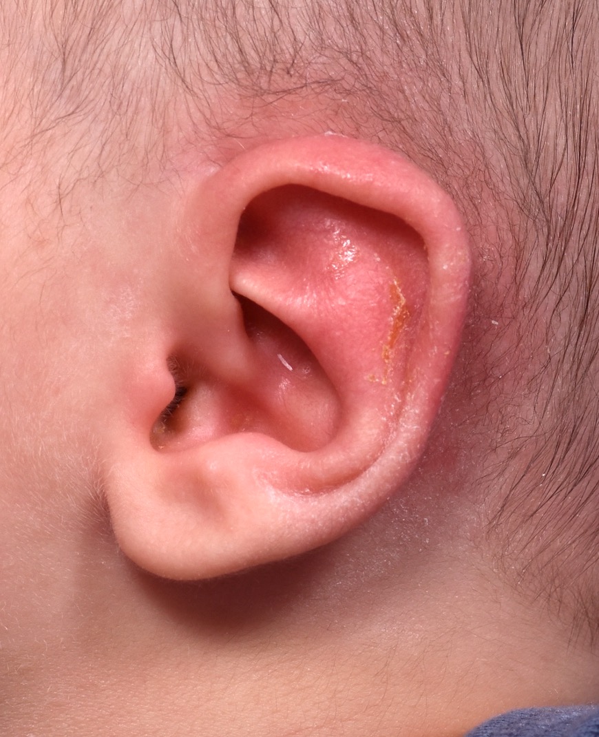 Earwell Atlanta Aviva baby ear before after expert best