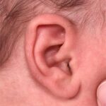 Earwell Atlanta Aviva baby ear before after expert best