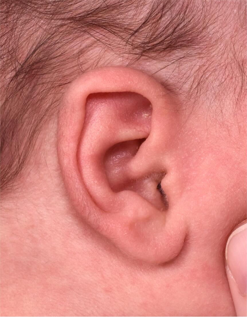 Earwell Atlanta Aviva baby ear before after expert best
