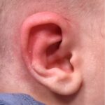 Earwell Atlanta Aviva baby ear before after expert best