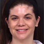 Buccal fat reduction Atlanta surgery best expert facial balancing