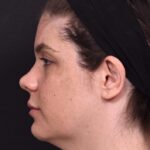 Buccal fat reduction Atlanta surgery best expert facial balancing