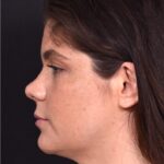 Buccal fat reduction Atlanta surgery best expert facial balancing