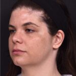 Buccal fat reduction Atlanta surgery best expert facial balancing