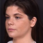 Buccal fat reduction Atlanta surgery best expert facial balancing