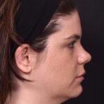 Buccal fat reduction Atlanta surgery best expert facial balancing