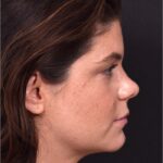 Buccal fat reduction Atlanta surgery best expert facial balancing