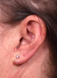 Atlanta earlobe repair piercing stretched too low before after fix ear