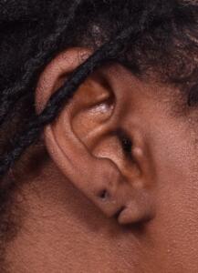 Aviva Atlanta earlobe stretched torn piercing repair before after best