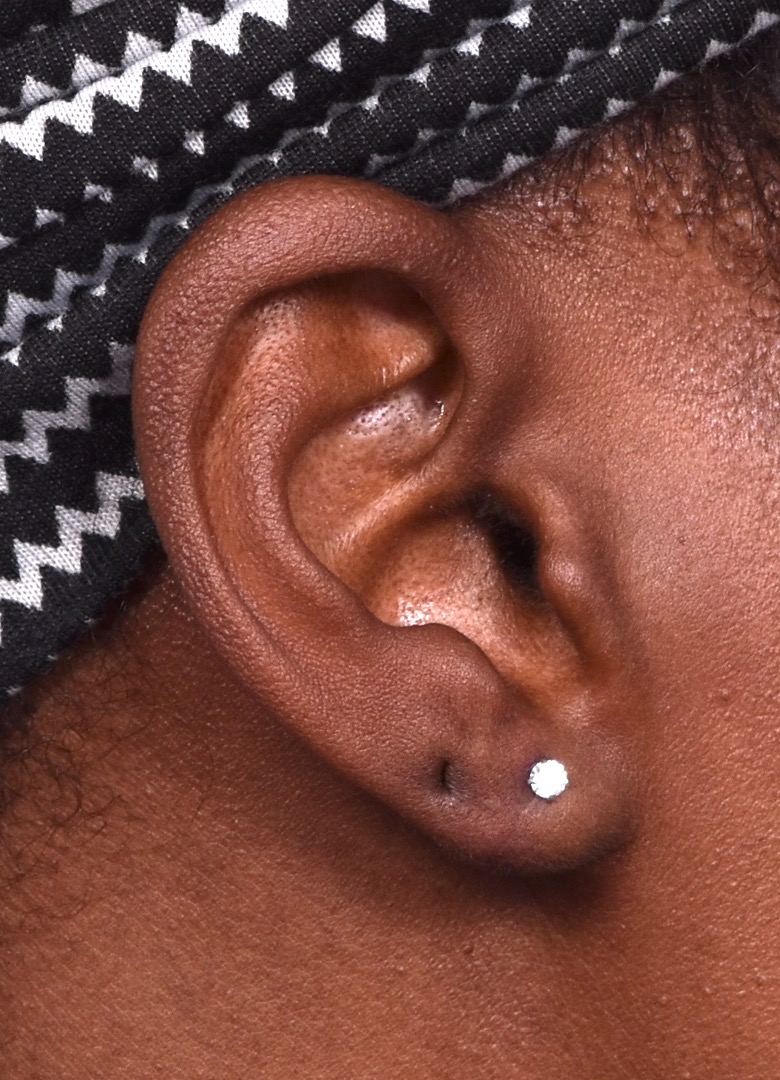 Aviva Atlanta earlobe stretched torn piercing repair before after best