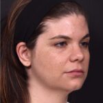 FaceTite Morpheus buccal fat reduction liposuction best Atlanta expert