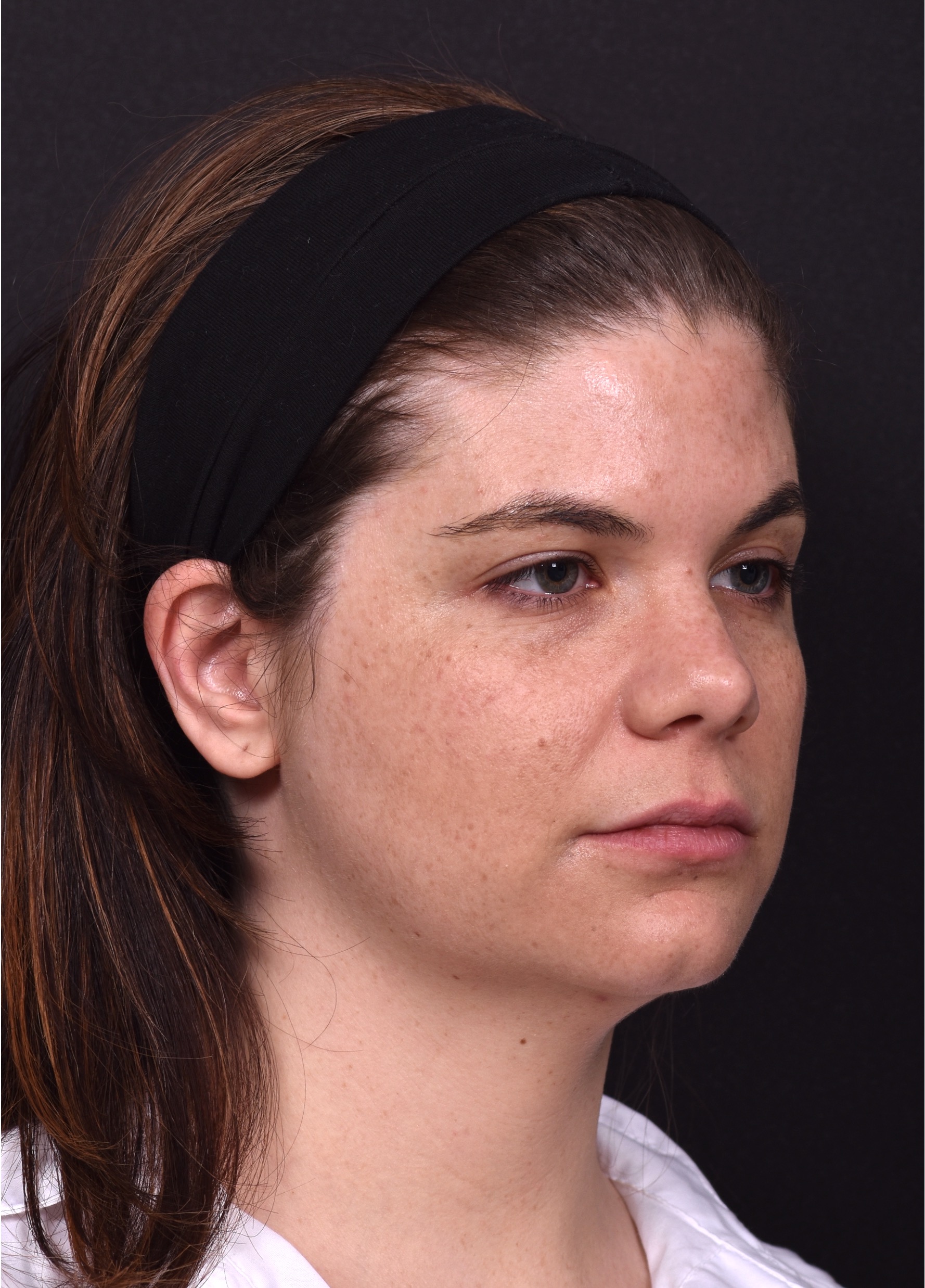 FaceTite Morpheus buccal fat reduction liposuction best Atlanta expert
