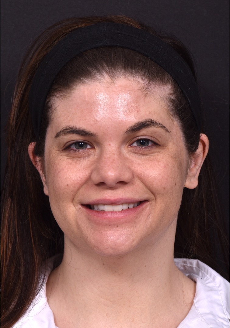FaceTite Morpheus buccal fat reduction liposuction best Atlanta expert