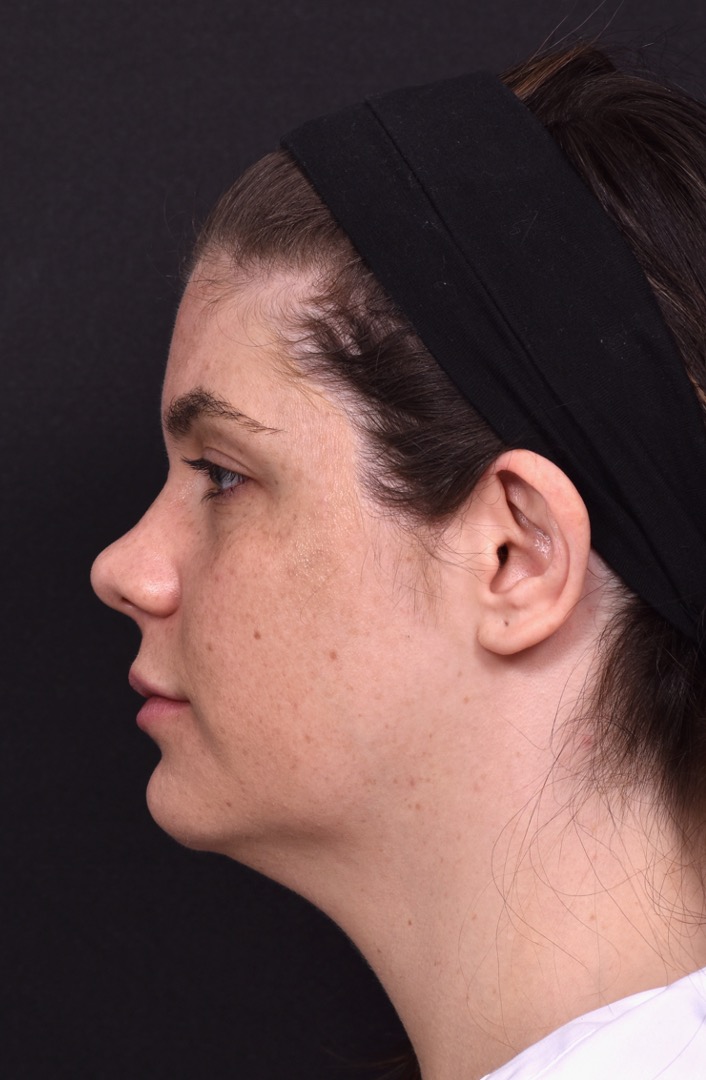 FaceTite Morpheus buccal fat reduction liposuction best Atlanta expert