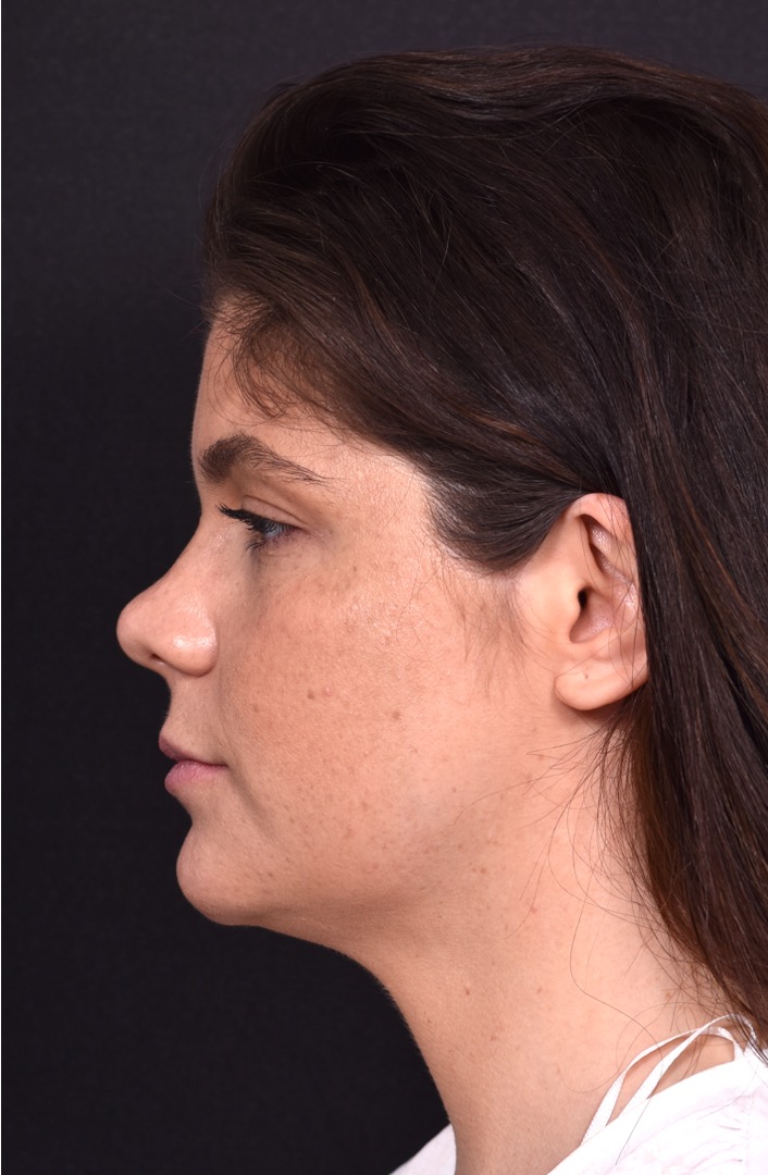 FaceTite Morpheus buccal fat reduction liposuction best Atlanta expert