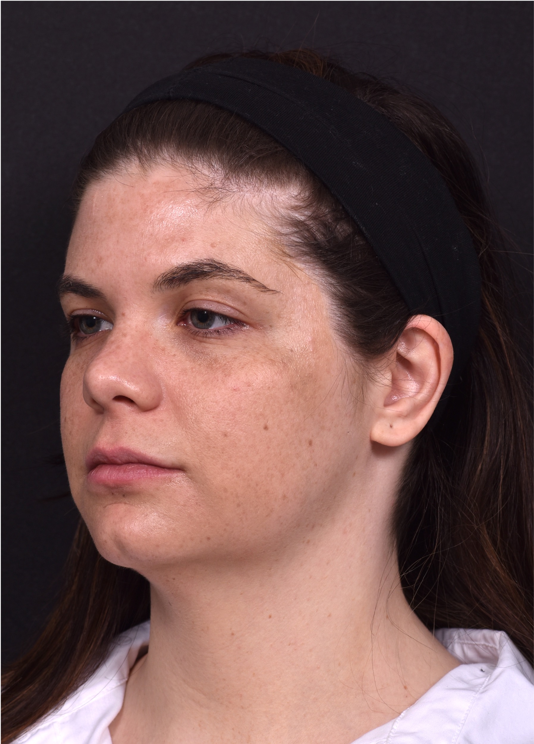 FaceTite Morpheus buccal fat reduction liposuction best Atlanta expert