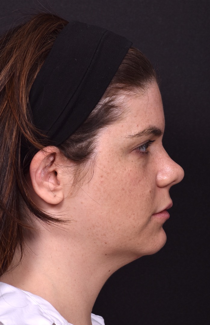 FaceTite Morpheus buccal fat reduction liposuction best Atlanta expert