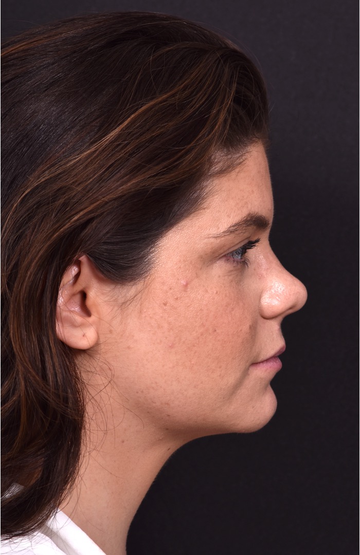 FaceTite Morpheus buccal fat reduction liposuction best Atlanta expert