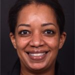 Osteoma forehead bump lump surgery treatment best expert