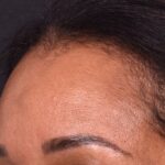 Osteoma forehead bump lump surgery treatment best expert