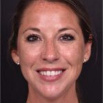 Aviva Atlanta facial balancing fillers lip filler before after expert best
