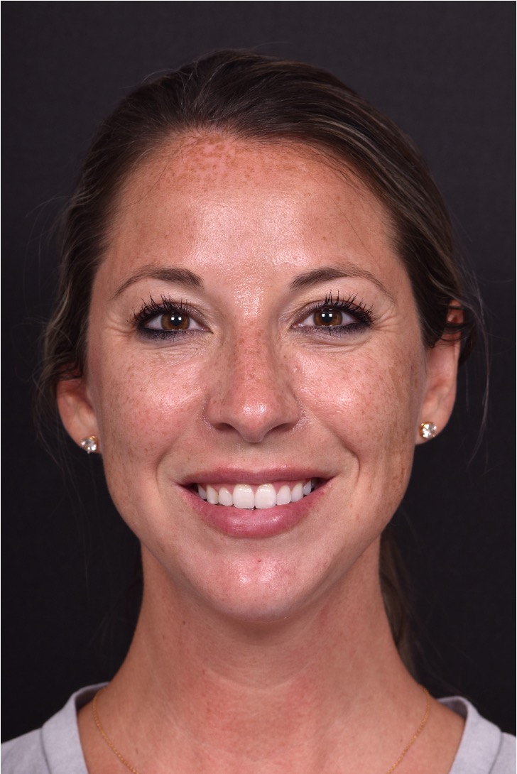 Aviva Atlanta facial balancing fillers lip filler before after expert best