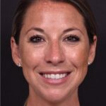 Aviva Atlanta facial balancing fillers lip filler best expert before after