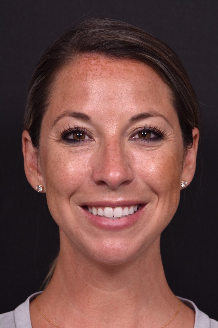 Aviva Atlanta facial balancing fillers lip filler best expert before after