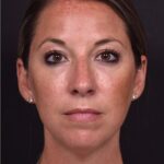 Aviva Atlanta facial balancing fillers lip filler best expert before after