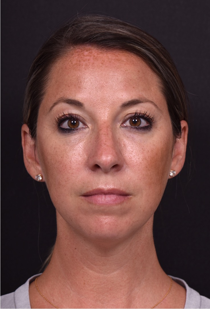 Aviva Atlanta facial balancing fillers lip filler best expert before after