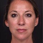 Aviva Atlanta facial balancing fillers lip filler best expert before after