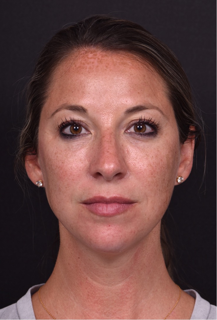 Aviva Atlanta facial balancing fillers lip filler best expert before after