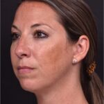 Aviva Atlanta facial balancing fillers lip filler best expert before after