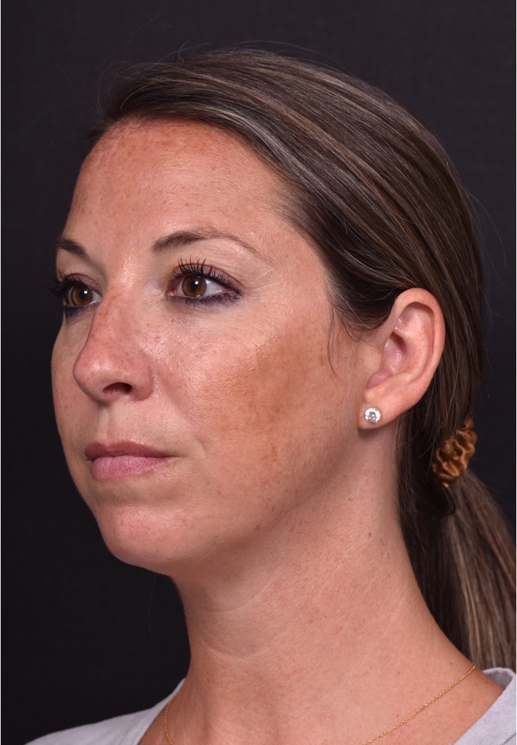 Aviva Atlanta facial balancing fillers lip filler best expert before after