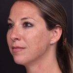 Aviva Atlanta facial balancing fillers lip filler best expert before after