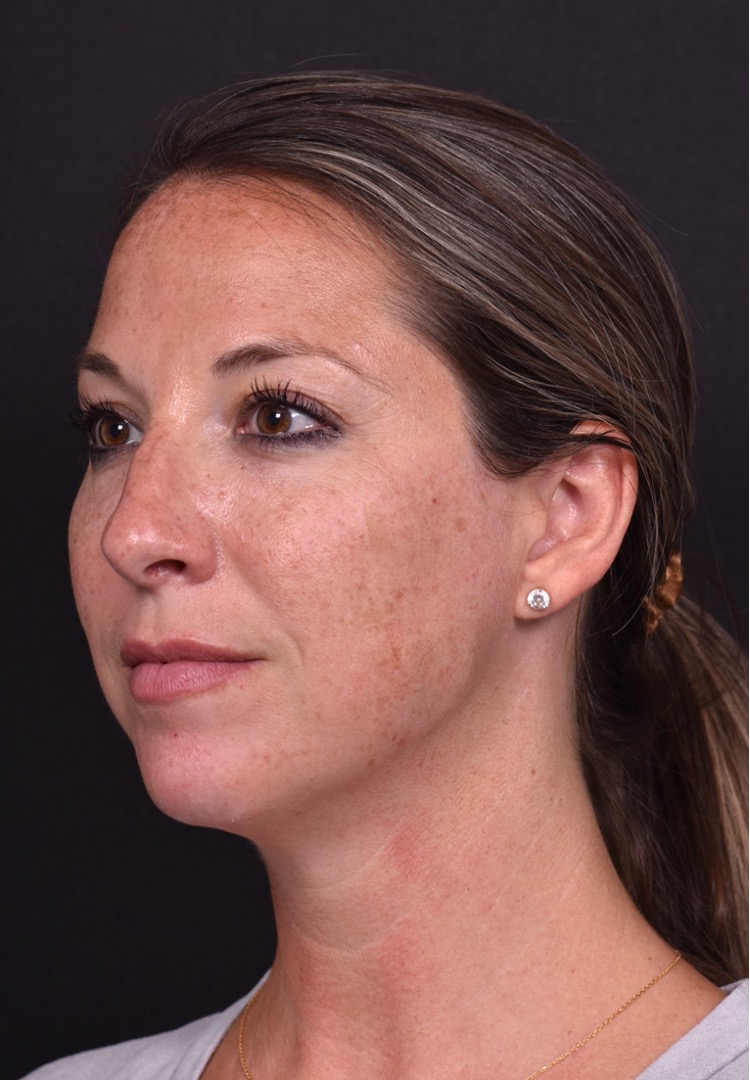 Aviva Atlanta facial balancing fillers lip filler best expert before after