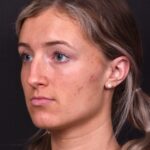 Atlanta preservation rhinoplasty ultrasonic before after expert top Atlanta nose job best