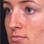 Atlanta preservation rhinoplasty ultrasonic before after expert top Atlanta nose job best