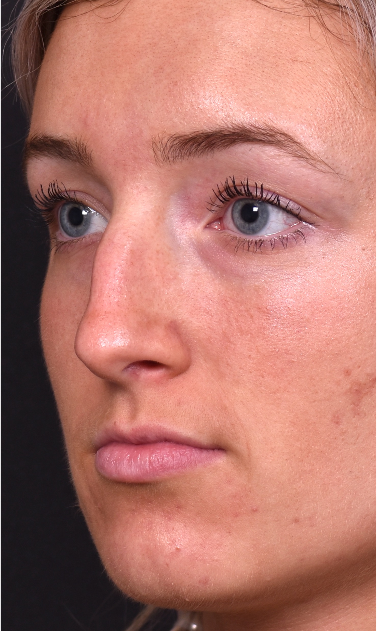 Atlanta preservation rhinoplasty ultrasonic before after expert top Atlanta nose job best