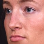 Atlanta preservation rhinoplasty ultrasonic before after expert top Atlanta nose job best